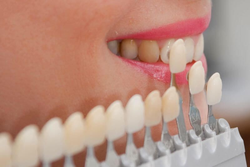 Teeth whitening | Dental Shop