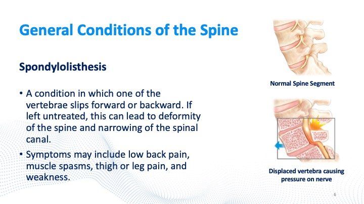 Spondylolisthesis images