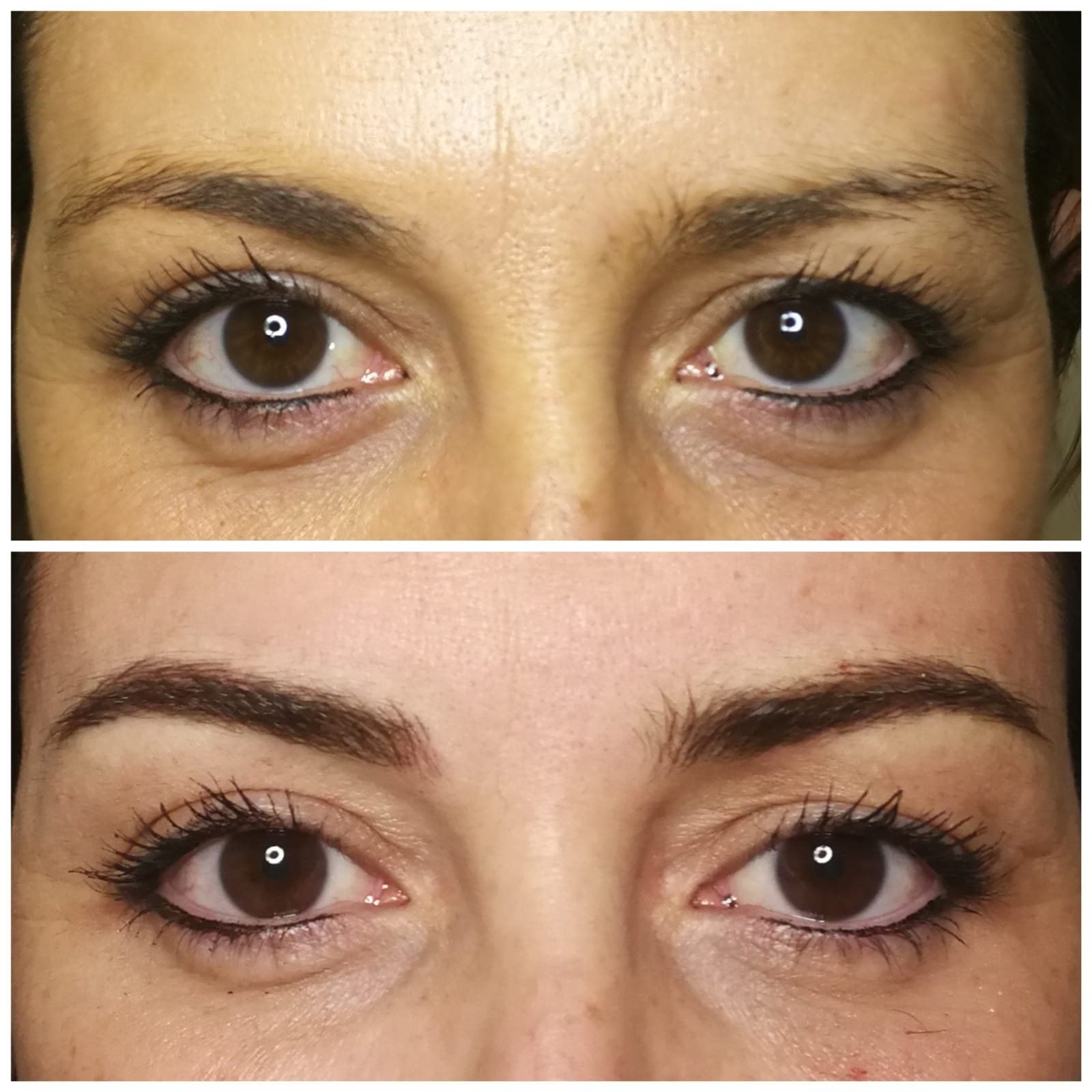Foto prima e dopo che mostrano una riduzione delle rughe sotto gli occhi, sopracciglia più scure e un eyeliner più marcato.