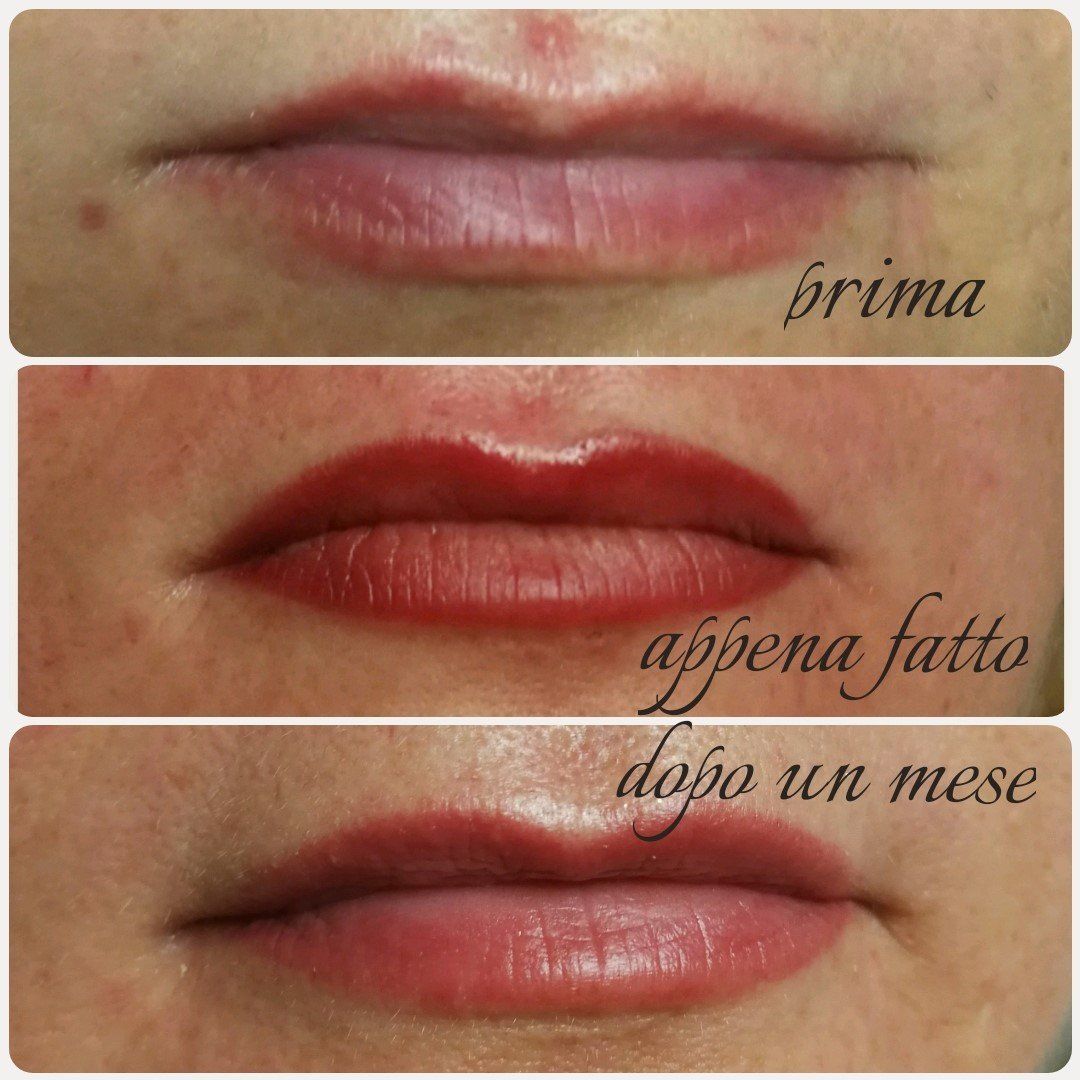Labbra prima, subito dopo e un mese dopo la procedura di arrossamento delle labbra, che mostrano un cambiamento di colore.