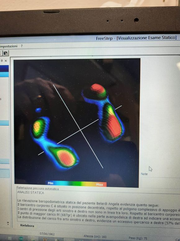 esame baropodometrico computerizzato per la realizzazione di plantari ortopedici
