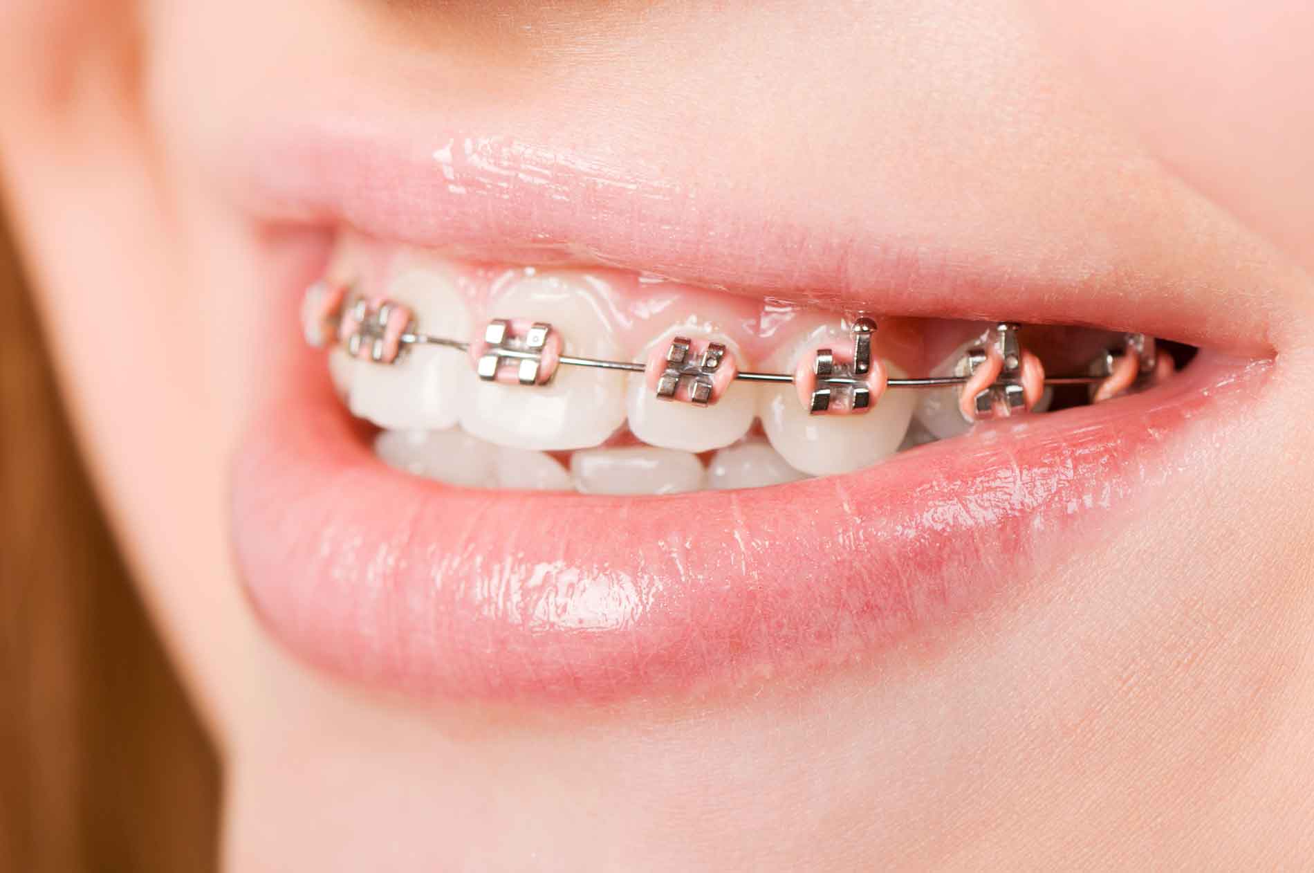 aparelho dentário fixo invisível