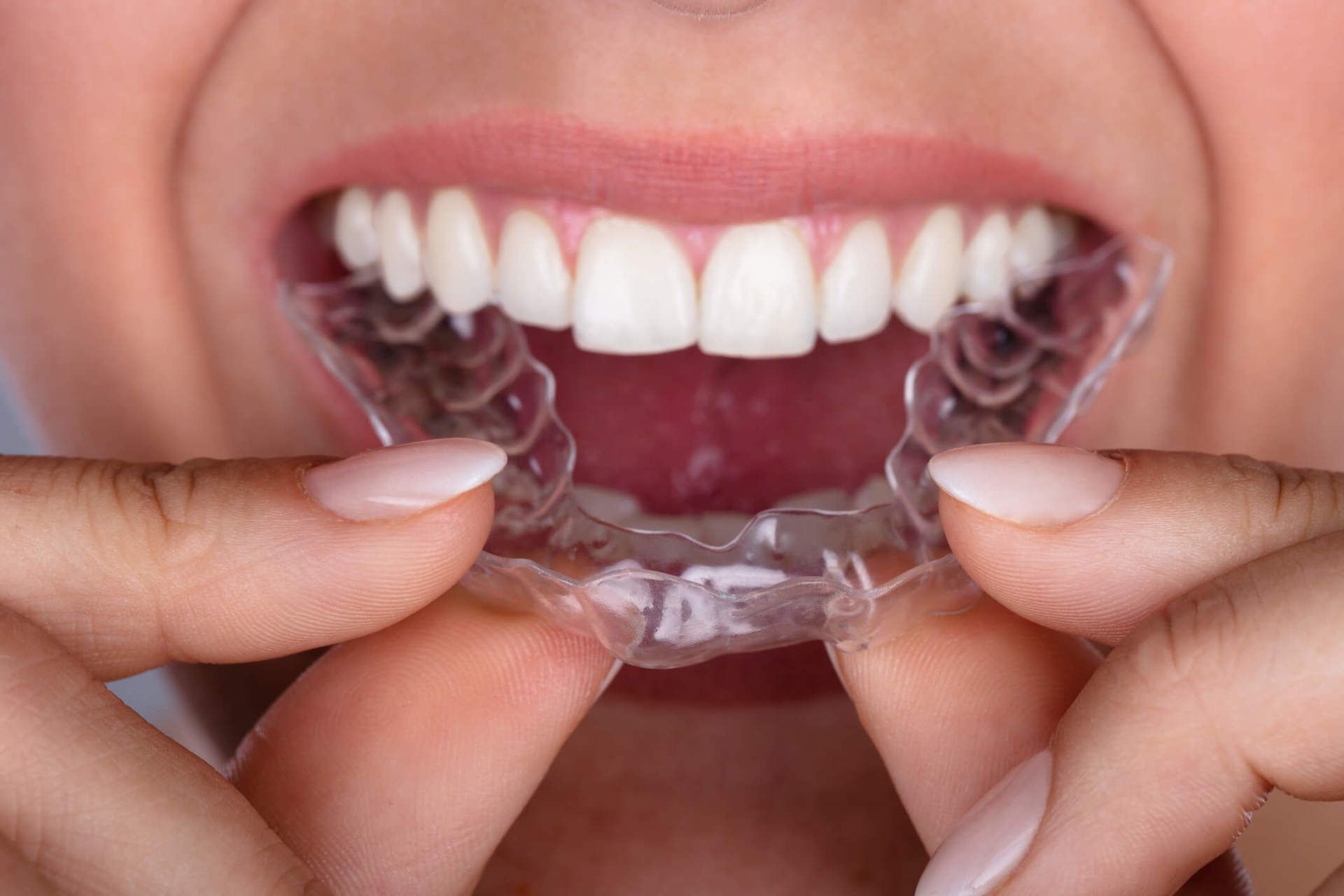 noticia sobre invisalign