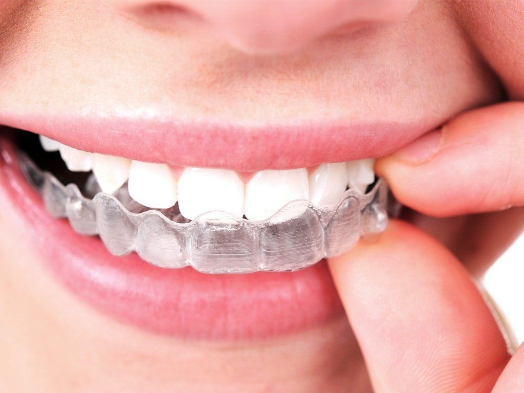 tecnologia invisalign