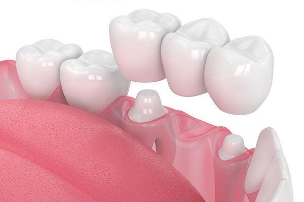Crowns and Bridges — Urbana, IL — J. Barry Howell DDS Crowns and Bridges — Urbana, IL — J. Barry Howell DDS