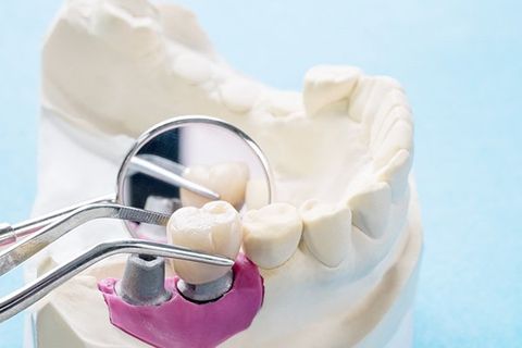 Implants — Urbana, IL — J. Barry Howell DDS Implants — Urbana, IL — J. Barry Howell DDS