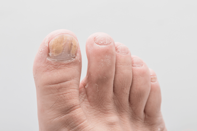 Ingrown Nails — Fungus Toenails in Jackson, MI Ingrown Nails — Fungus Toenails in Jackson, MI