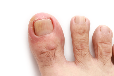 Foot Care Doctor — Ingrown Toenails in Jackson, MI Foot Care Doctor — Ingrown Toenails in Jackson, MI