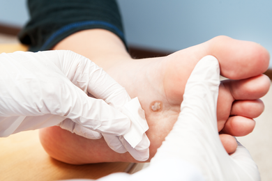 Warts Care — Treating of Warts in Jackson, MI Warts Care — Treating of Warts in Jackson, MI