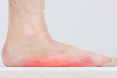 Podiatrist Jackson MI — Flat Feet in Jackson, MI Podiatrist Jackson MI — Flat Feet in Jackson, MI