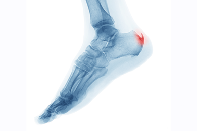 Foot Care — Heel Spurs in Jackson, MI Foot Care — Heel Spurs in Jackson, MI