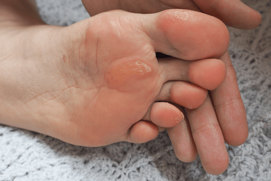 Bunion — Feet Wearing Orthopedic Pads in Jackson, MI Bunion — Feet Wearing Orthopedic Pads in Jackson, MI