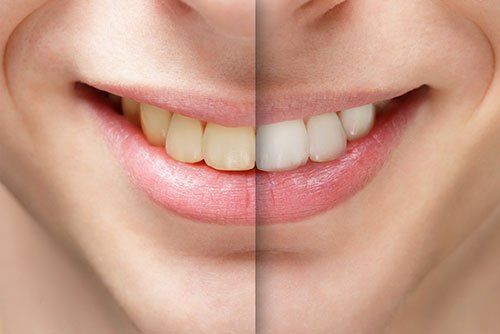 Fluoride Dental Treatment Services in East Chapman Ave. Orange, CA