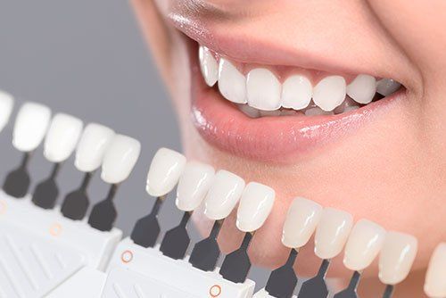 dental veneers in Orange California