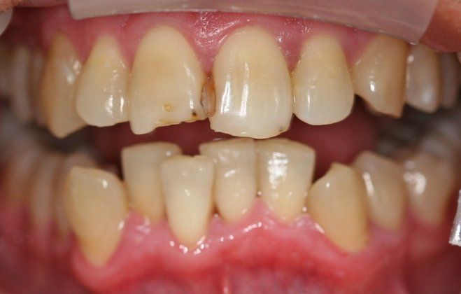 Arnold patient at E.C.O. Dental, Instant Orthodontics in Orange CA, Orthodontist Orange CA, Veneers in Orange CA