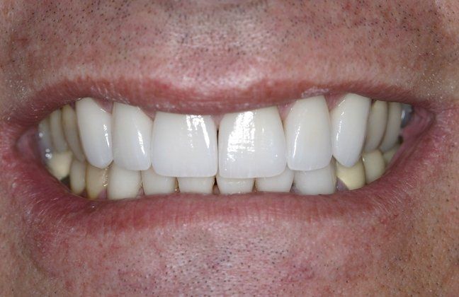 Bill patient at E.C.O. Dental, Instant Orthodontics in Orange CA, Orthodontist Orange CA, Veneers in Orange CA