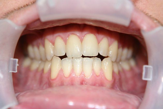 Daniel patient at E.C.O. Dental, Instant Orthodontics in Orange CA, Orthodontist Orange CA, Veneers in Orange CA