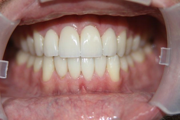 Daniel patient at E.C.O. Dental, Instant Orthodontics in Orange CA, Orthodontist Orange CA, Veneers in Orange CA