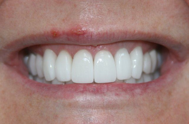 Darlene patient at E.C.O. Dental, Instant Orthodontics in Orange CA, Orthodontist Orange CA, Veneers in Orange CA