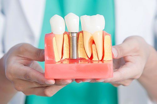 dental implants services in East Chapman Ave. Orange, CA