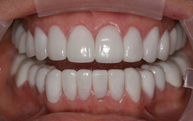 Gloria patient at E.C.O. Dental, Full Mouth Reconstruction in Orange CA, Cosmetic Dentistry Orange CA