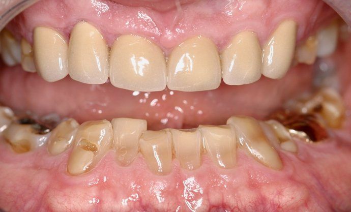 Greg patient at E.C.O. Dental, Full Mouth Reconstruction in Orange CA, Cosmetic Dentistry Orange CA