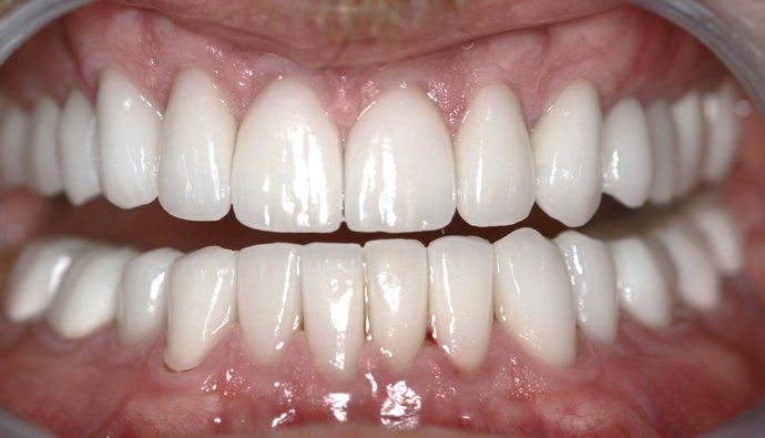 Greg patient at E.C.O. Dental, Full Mouth Reconstruction in Orange CA, Cosmetic Dentistry Orange CA