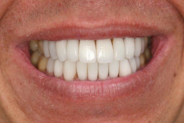 Joe patient at E.C.O. Dental, Instant Orthodontics in Orange CA, Orthodontist Orange CA, Veneers in Orange CA