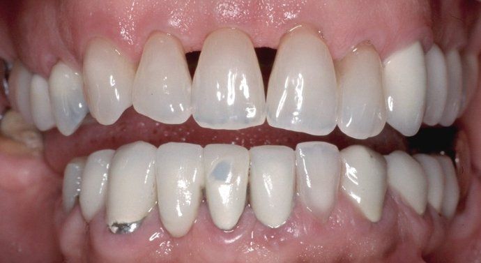 Joyce patient at E.C.O. Dental, Full Mouth Reconstruction in Orange CA, Cosmetic Dentistry Orange CA
