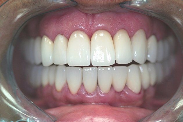 Joyce patient at E.C.O. Dental, Full Mouth Reconstruction in Orange CA, Cosmetic Dentistry Orange CA