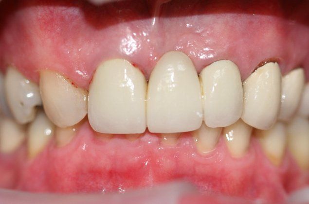 Judith patient at E.C.O. Dental, Full Mouth Reconstruction in Orange CA, Cosmetic Dentistry Orange CA