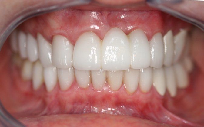 Judith patient at E.C.O. Dental, Full Mouth Reconstruction in Orange CA, Cosmetic Dentistry Orange CA