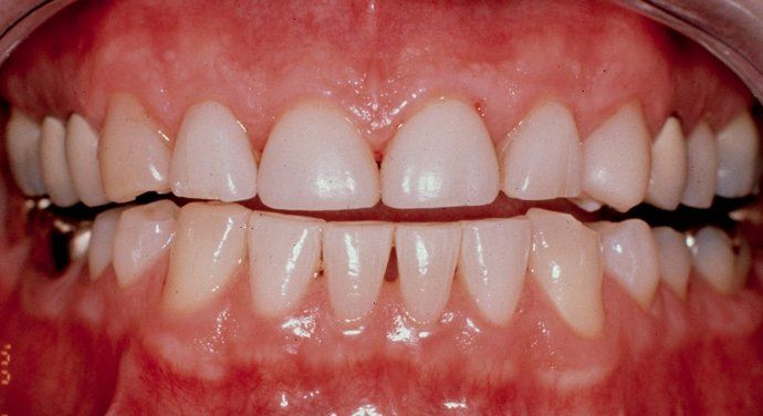 Karl patient at E.C.O. Dental, Full Mouth Reconstruction in Orange CA, Cosmetic Dentistry Orange CA