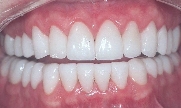 Karl patient at E.C.O. Dental, Full Mouth Reconstruction in Orange CA, Cosmetic Dentistry Orange CA