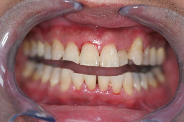 Koi patient at E.C.O. Dental, Full Mouth Reconstruction in Orange CA, Cosmetic Dentistry Orange CA
