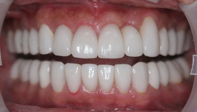 Koi patient at E.C.O. Dental, Full Mouth Reconstruction in Orange CA, Cosmetic Dentistry Orange CA
