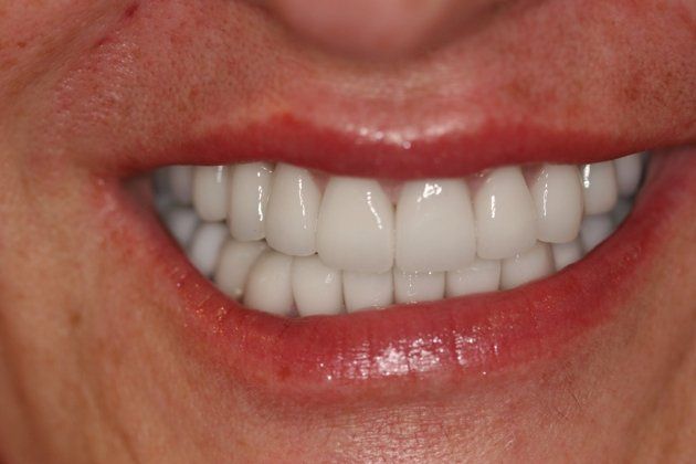 Laraine patient at E.C.O. Dental, Full Mouth Reconstruction in Orange CA, Cosmetic Dentistry Orange CA