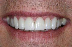 Mike patient at E.C.O. Dental, Instant Orthodontics in Orange CA, Orthodontist Orange CA, Veneers in Orange CA