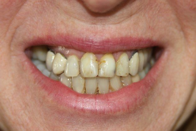 Patricia patient at E.C.O. Dental, Instant Orthodontics in Orange CA, Orthodontist Orange CA, Veneers in Orange CA