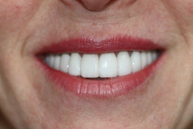 Patricia patient at E.C.O. Dental, Instant Orthodontics in Orange CA, Orthodontist Orange CA, Veneers in Orange CA
