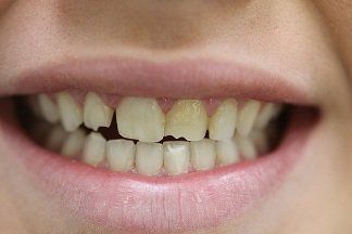 Payton patient at E.C.O. Dental, Instant Orthodontics in Orange CA, Orthodontist Orange CA, Veneers in Orange CA