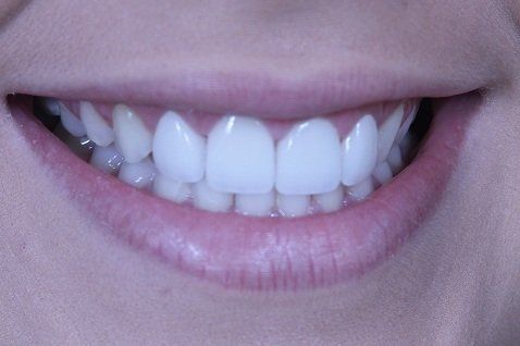 Payton patient at E.C.O. Dental, Instant Orthodontics in Orange CA, Orthodontist Orange CA, Veneers in Orange CA
