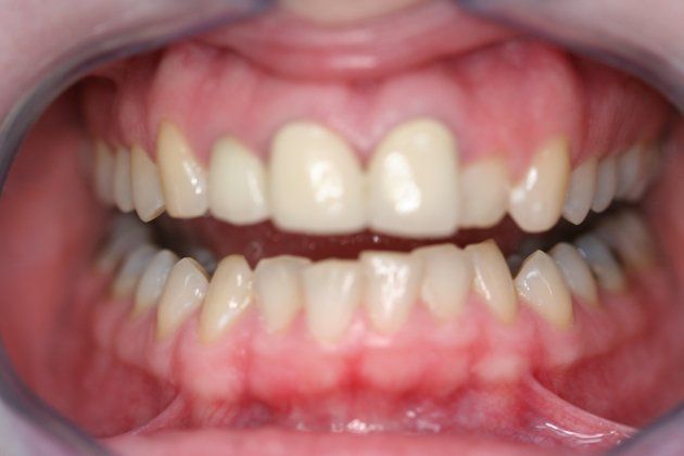 Rachel patient at E.C.O. Dental, Instant Orthodontics in Orange CA, Orthodontist Orange CA, Veneers in Orange CA