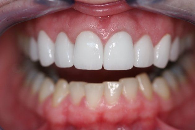 Rachel patient at E.C.O. Dental, Instant Orthodontics in Orange CA, Orthodontist Orange CA, Veneers in Orange CA