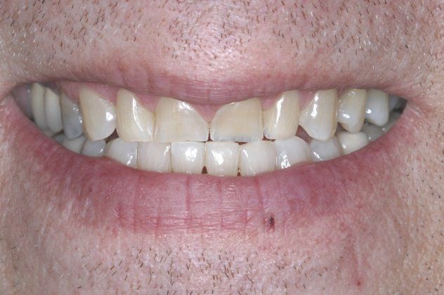 Richard patient at E.C.O. Dental, Full Mouth Reconstruction in Orange CA, Cosmetic Dentistry Orange CA