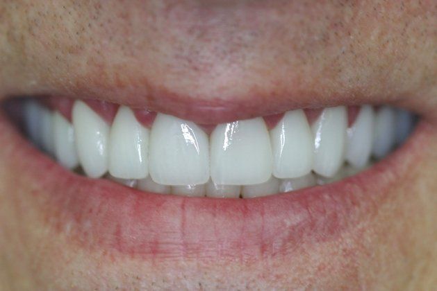 After Results, Richard patient at E.C.O. Dental, Full Mouth Reconstruction in Orange CA, Cosmetic Dentistry Orange CA