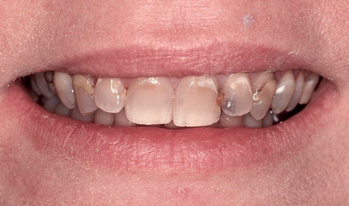 Sheri patient at E.C.O. Dental, Full Mouth Reconstruction in Orange CA, Cosmetic Dentistry Orange CA