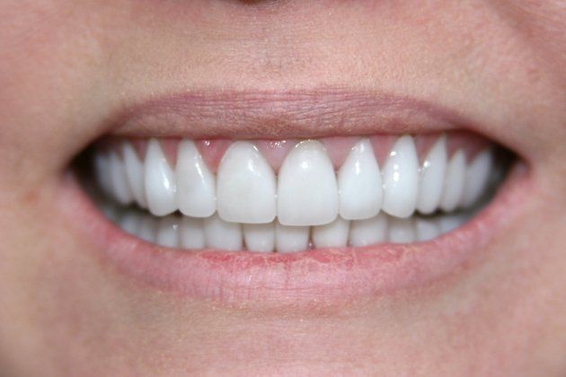 Sheri patient at E.C.O. Dental, Full Mouth Reconstruction in Orange CA, Cosmetic Dentistry Orange CA
