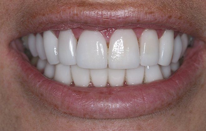 Stacy patient at E.C.O. Dental, Instant Orthodontics in Orange CA, Orthodontist Orange CA, Veneers in Orange CA