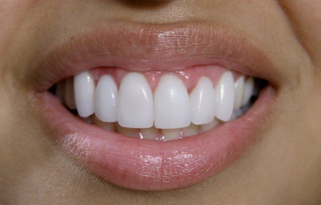 Xytlolec patient at E.C.O. Dental, Instant Orthodontics in Orange CA, Orthodontist Orange CA, Veneers in Orange CA